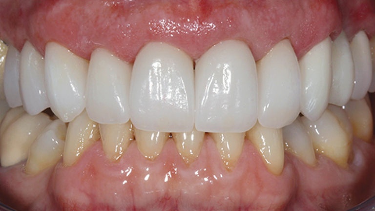 All-ceramic IPS e.max crowns were chosen for their lifelike esthetics and ease of cementation.