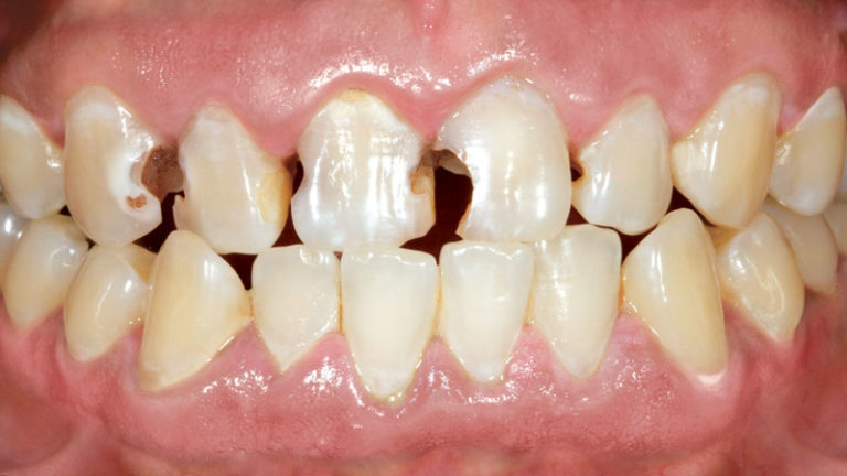 Este paciente tenía varios dientes con caries extremas. Se colocaron coronas IPS e.max en los dientes #6–11. También fue necesario realizar endodoncias.