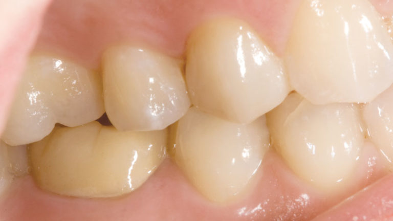 Because the patient was concerned about metal showing in the mouth, IPS e.max was used. Note its lifelike esthetics.