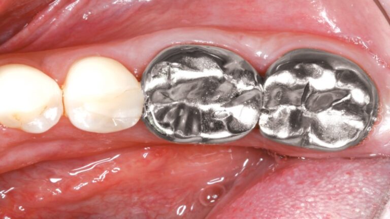 Coronas Metálicas (No Precioso) - Glidewell Dental México