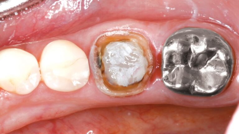 Coronas Metálicas (No Precioso) - Glidewell Dental México